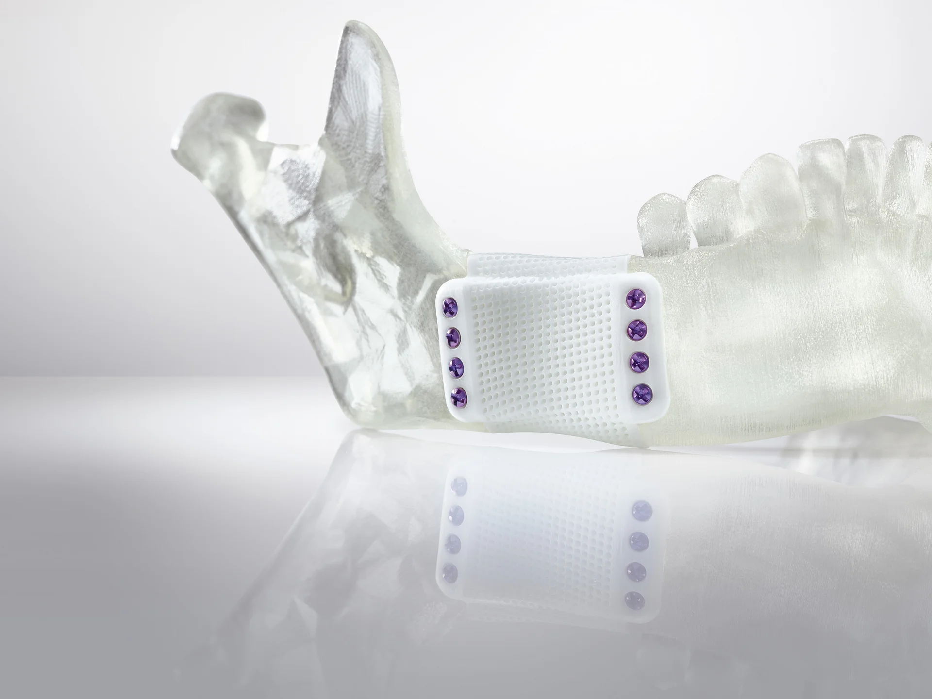 Kieferimplantat Lithoz Additiv gefertigtes keramisches Kieferimplantat